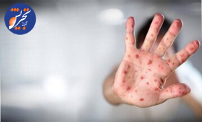 گزارش جدید سازمان جهانی بهداشت از شیوع سرخک