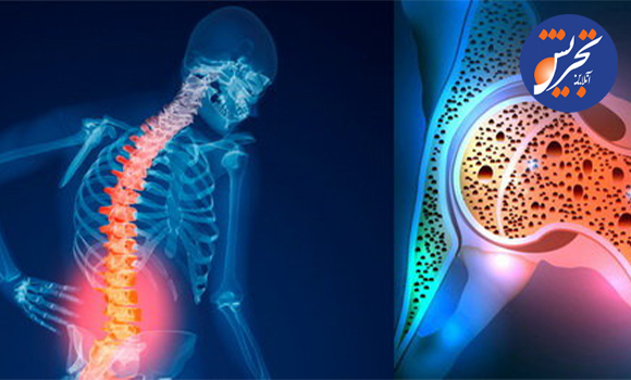 هشدار متخصصان ارتوپد درباره مصرف زیاد یک نوشیدنی